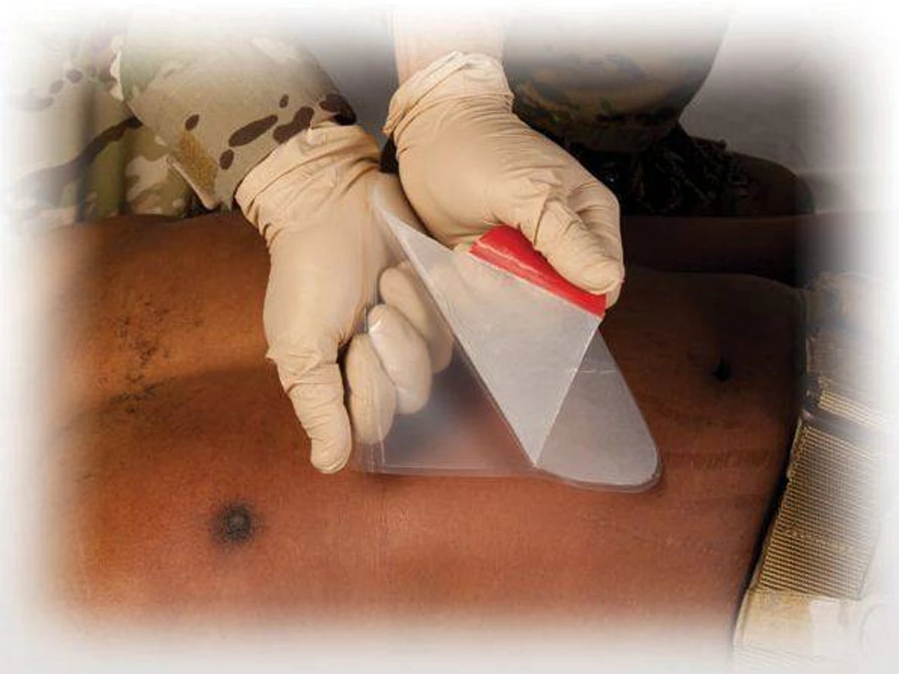 North American Rescue HyFin Vent Chest Seal 11 North American Rescue HyFin Vent Chest Seal - Image 9