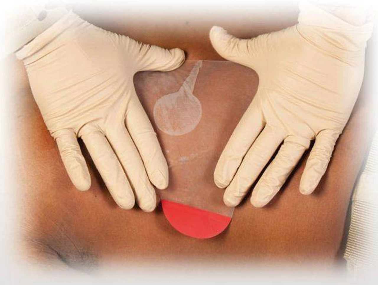 North American Rescue HyFin Vent Chest Seal 16 North American Rescue HyFin Vent Chest Seal - Image 14